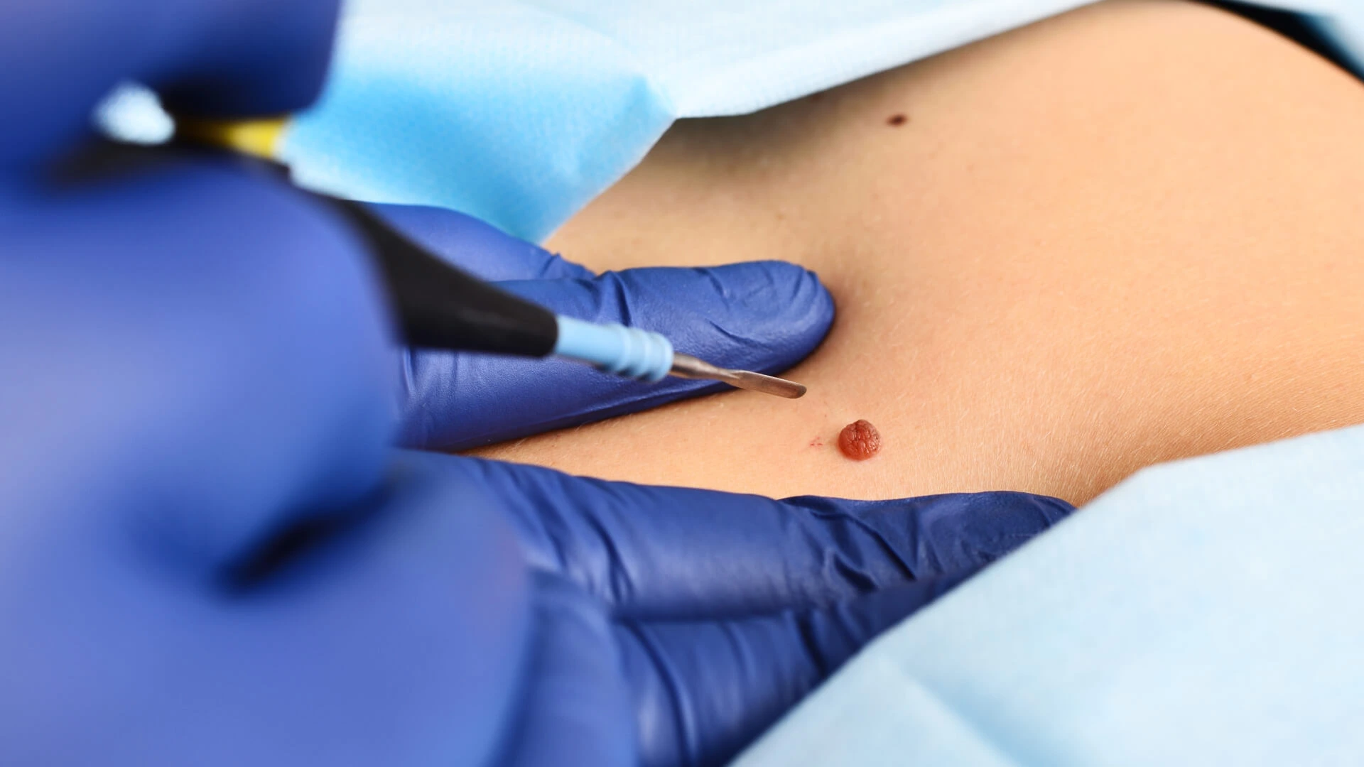 Cirurgia Dermatológica 02